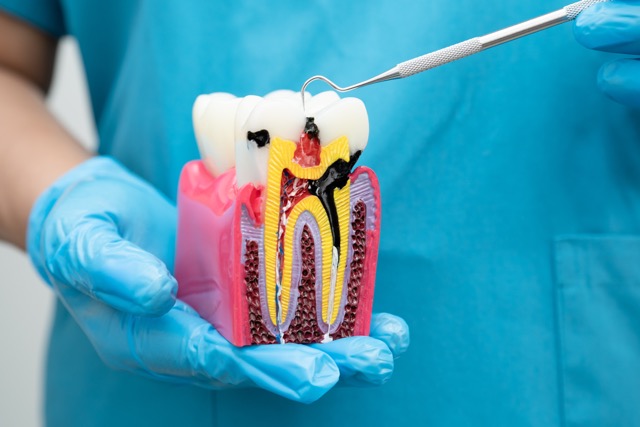 Sleep Dentistry for Root Canal Treatment