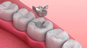 Safe Amalgam Mercury Removal