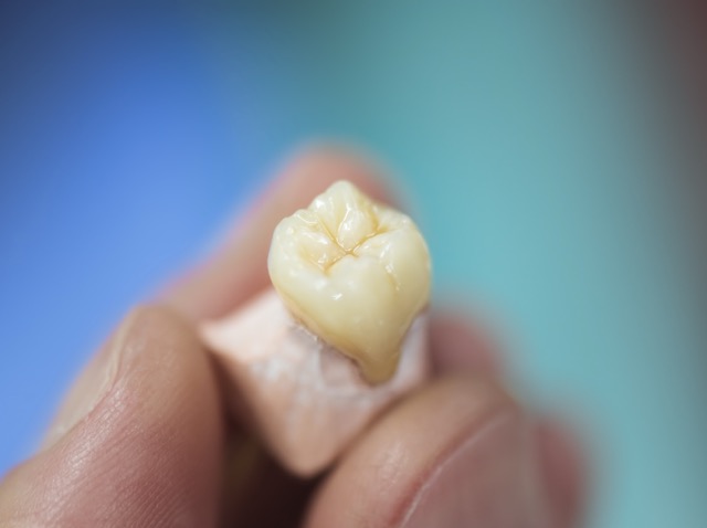 Sleep Dentistry for Dental Crowns & Bridges