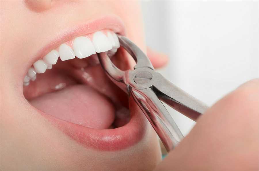 Sleep Dentistry for Wisdom Tooth Removal